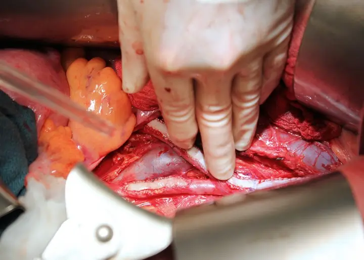 Vascular Surgery